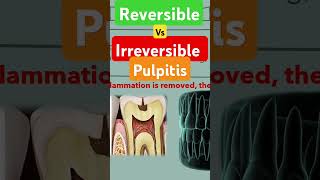 Reversible vs irreversible pulpitis [upl. by Benetta399]