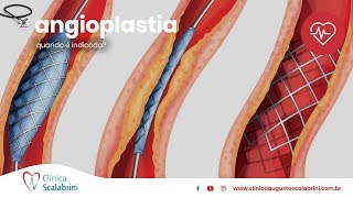 Quando é Indicada a Angioplastia [upl. by Kimball]