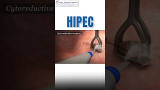 What is HIPEC  Cancer treatment cancertreatment hipec [upl. by Anaoy36]