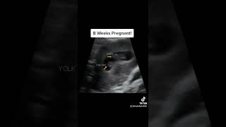 8 weeks pregnant ultrasound Baby with yolk sac [upl. by Harmon]