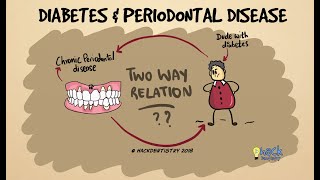 Diabetes and periodontitis The two way relationship [upl. by Erde839]