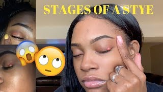 STAGES OF A STYE  CURE 👁 [upl. by Gniliem674]