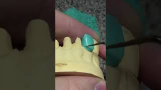 Моделировка центрального редцп dentist виниры orthodontist стоматология smile [upl. by Oruntha]