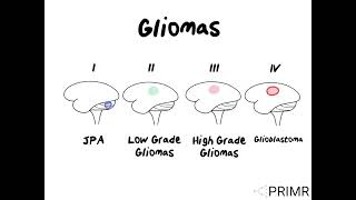 Glioma Brain Tumor [upl. by Buzzell]