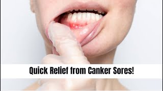 Canker Sores Causes Symptoms and Remedies  Mind Musings sores mouthulcer dentistry [upl. by Aiekahs]