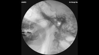 TRIGEMINAL NEURALGIA  RF NERVE ABLATION TREATMENT DR NEERAJ JAIN MD FIMSA CIPSHung FIPPUSA [upl. by Ivets961]