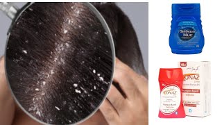 sir ki Khushi or dandruff ka ilaj Urdu handi Conaz lotion shampoo sulsun blue shampoo [upl. by Suravat]