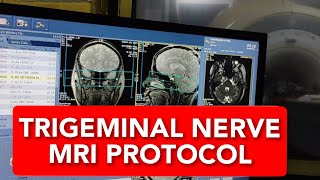 Trigeminal Nerve MRI scan protocol positioning and planning [upl. by Cykana154]