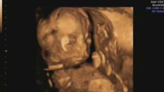 19 week ultrasound Its a girl Includes 3d4d scan [upl. by Robert687]