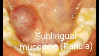 Sublingual mucocele  Ranula surgically removed by Laser [upl. by Cam]