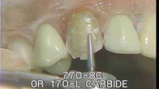 Maxillary Cuspid Preparation for a Porcelain Fused to Gold Crown [upl. by Byrann]