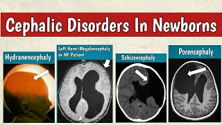 Cephalic Disorders In Newborns  Congenital Brain Malformations Radiology [upl. by Irahs]