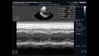 Ecocardiograma com Doppler Colorido da minha mulher [upl. by Eniarol370]