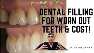 Cost of Dental Cement Restorations  Dr Arunkumar Pearls Dentistry Chennai  Fillings for Abrasions [upl. by Oiluig]