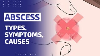 ABSCESS  TYPES SYMPTOMS CAUSES amp TREATMENT [upl. by Mungovan]