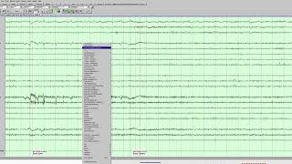 Left temporal slowing and epileptiform activity [upl. by Anuat]