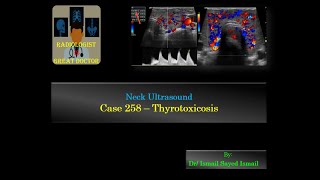 Ultrasound Case 258  Thyrotoxicosis [upl. by Ayit]