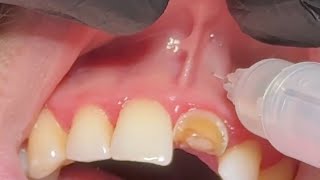 Local Anesthesia For Extraction Upper Central incisor  anterior superior and nasopalatine nerve [upl. by Heinrich]