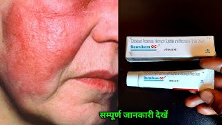 Dermikem oc cream benefits uses amp side effects in hindi dermikem oc cream uses in hindi [upl. by Oecam]