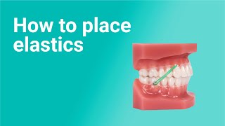 How to Place Elastics with Clear Aligners 9 Ortho Pro techniques [upl. by Rolyat]