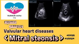 Mitral stenosis MS 승모판 협착증 심장판막 이첨판 판막질환echocardiography 심장초음파 heart echo view [upl. by Danby413]