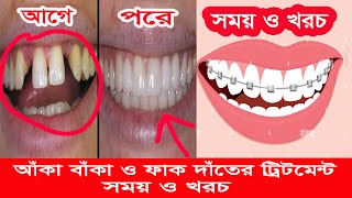 আঁকা বাঁকা দাঁত সোজা করা  aka baka dat soja korar upay ।।orthodontic treatment ।। uchu dat nichu [upl. by Zeuqram]