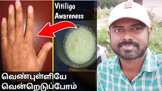 Vitiligo Awareness Motivation in Tamil [upl. by Pierpont306]