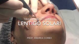 Lentigo Solari  Trattamento con Laser frazionato CO2 [upl. by Notirb]