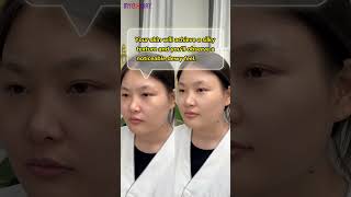 What Happens to Your Face After Microdermabrasion MicrodermabrasionResults [upl. by Siugram]