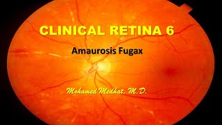 Clinical Retina 6  Amaurosis Fugax [upl. by Aicetel]