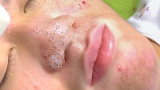 Big Cystic Acne Blackheads Extraction Blackheads amp Milia Whiteheads Removal Pimple Popping  5237 [upl. by Eurd]