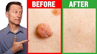 How to Rid Skin Tags and Warts Within 24 Hours  Dr Berg on Skin Tag Removal [upl. by Elvina]