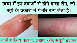 photosensitive eruption eczema disease फोटोसुग्रहित विस्फोट छाजन रोग का कारण लक्षण और संपूर्ण इलाज [upl. by Ingold]