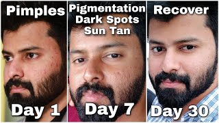 Do you have Dark Spots Pigmentation Just follow this for 100  gauranteed Result 👍  Tamil [upl. by Warila11]