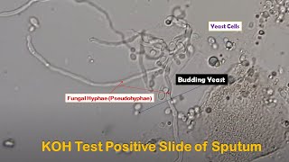 KOH Positive showing Fungal elements yeast cells budding and pseudohyphae in Sputum sample [upl. by Amol]