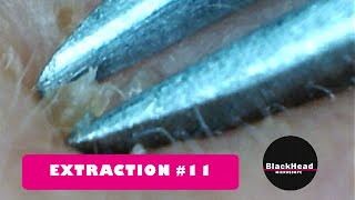 Whitehead and BlackHead RemovalExtraction 11 [upl. by Bergmann]