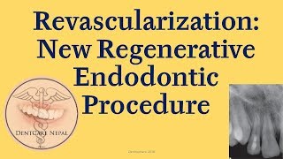 Revascularization  Regenerative Endodontic Procedure [upl. by Filmore]