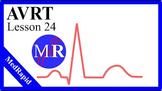 Atrioventricular Reentrant Tachycardia AVRT [upl. by Sorilda]