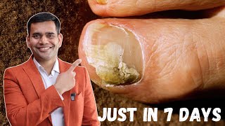 Just in 7 Days Cure Toenail Fungus At Home  Best Remedy For Toenail Fungus  Dr Vivek Joshi [upl. by Ahsimat]