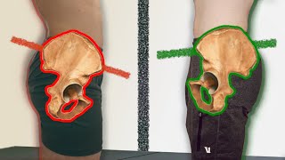 How Im FIXING my Anterior Pelvic Tilt [upl. by Llertnov]