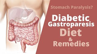 Diabetic Gastroparesis  Diet Modifications Causes and Treatment [upl. by Chatterjee406]