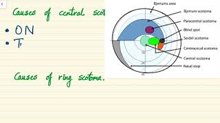 Visual field defects in POAG  Diagram  Causes of Central Scotoma and Ring Scotoma  Ocular signs [upl. by Meeki599]