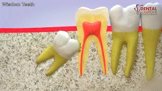 All you need to know about the eruption of a wisdom tooth [upl. by Sylado291]