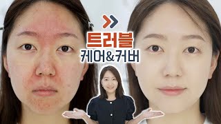 확 뒤집어진 피부 금방 나을 수 있습니다 가릴 수 있습니다 트러블피부케어법 피부 커버 방법 [upl. by Nimref]