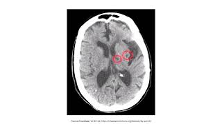 Cerebrovascular Disease for the USMLE Step 1 [upl. by Sharai]