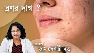 অ্যাকনে মার্কস সারাবেন কিভাবে  Dermatologist suggests treatment for Acne Marks [upl. by Johann]