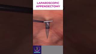 Laparoscopic Appendectomy  Appendicitis Treatment [upl. by Oicelem327]