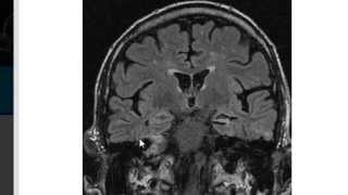 MRI in Epilepsy [upl. by Krusche]