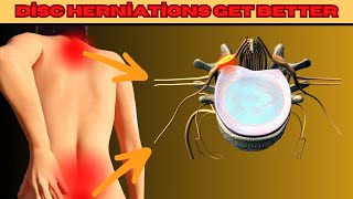 Can a Disc Herniation Heal Itself Spine Physical Therapy and Exercises [upl. by Imaj95]