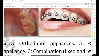 Orthodontic Appliances An Overview [upl. by Amos44]